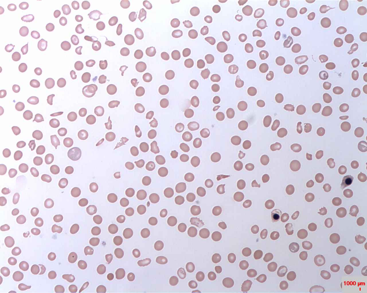 July 2024: Paroxysmal nocturnal hemoglobinuria (PNH)