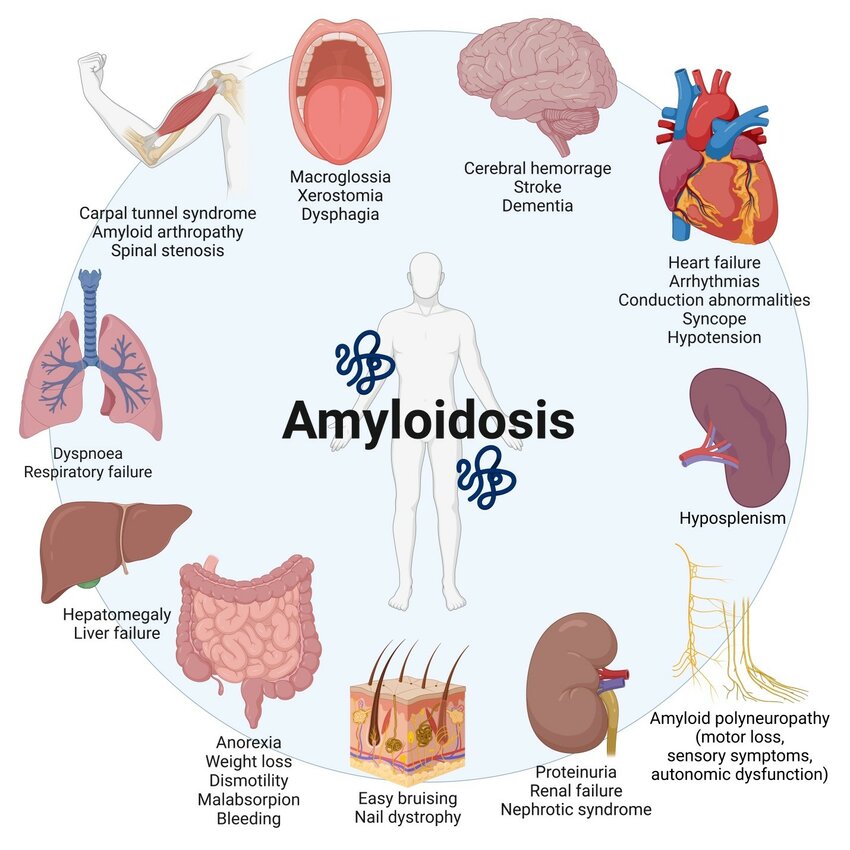 Week 1, March 2025: Advancing Immunotherapy for Amyloidosis: New Antibody Treatments and Investments