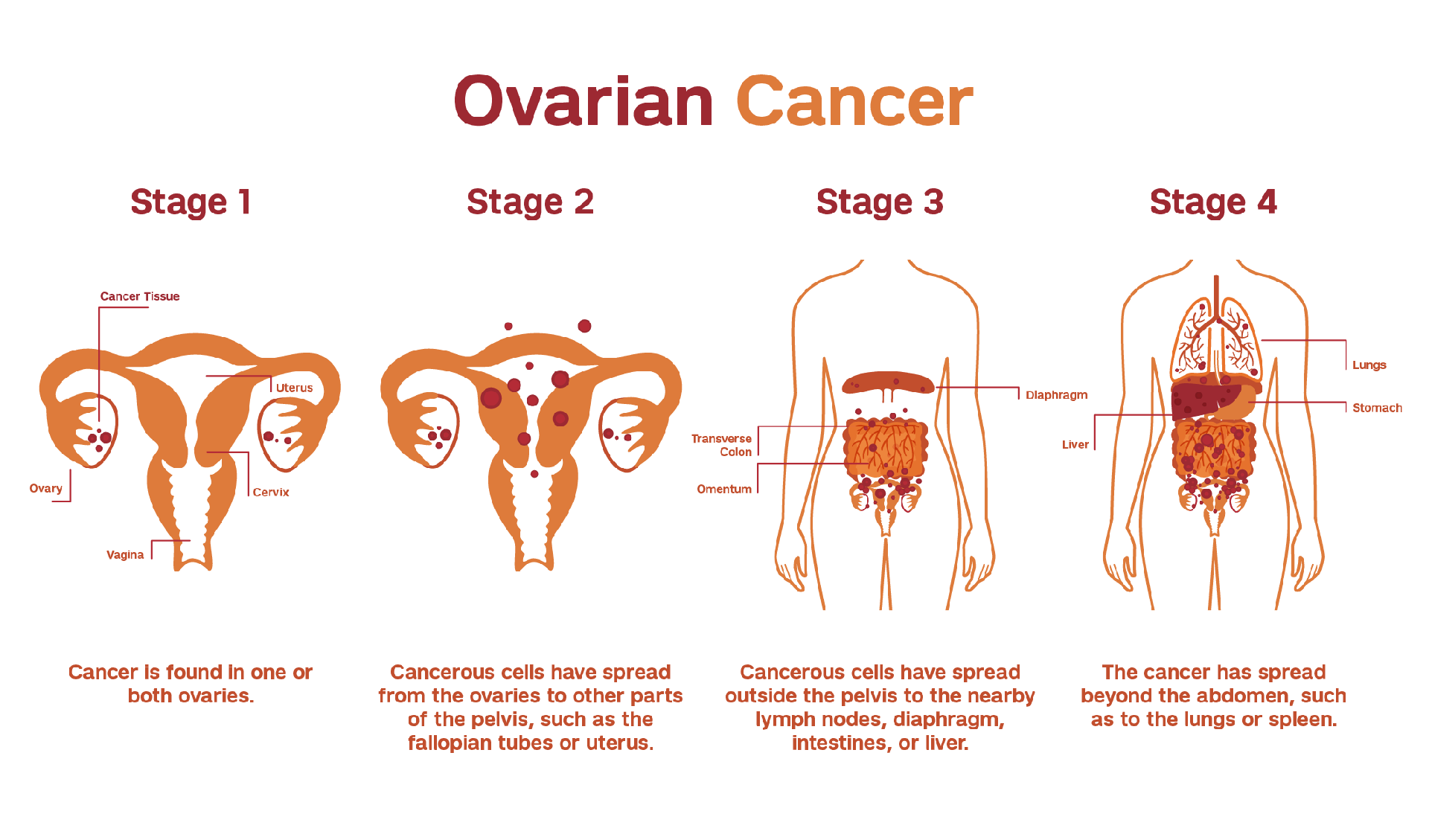 Week 3, April 2025: Antibody Therapeutics in Ovarian Cancer: The Next Wave