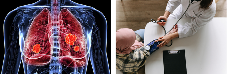 June 2025: Strategies and Advances in Non-Small Cell Lung Cancer (NSCLC)
