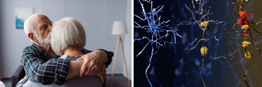 Alzheimer’s Disease