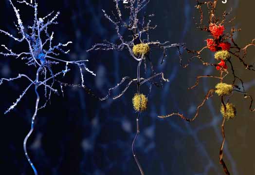 Alzheimer’s Disease - Hope for the Future